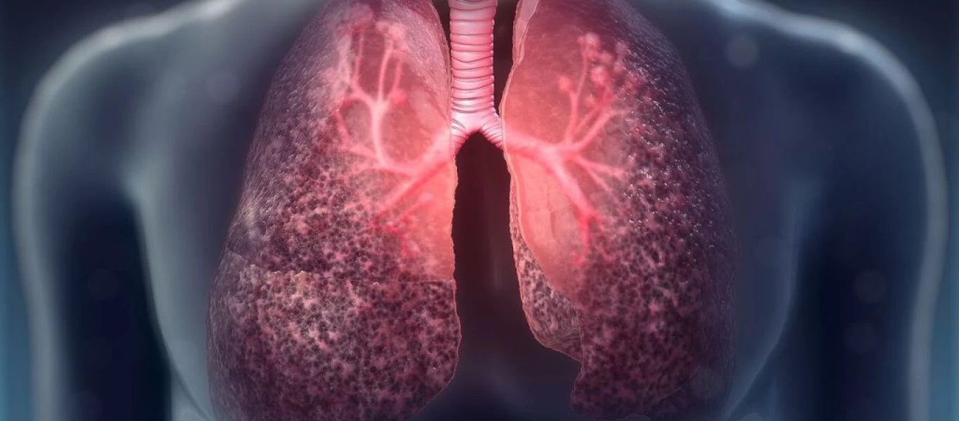 Τι είναι η κυστική ίνωση και πως προστατεύετε το παιδί σας